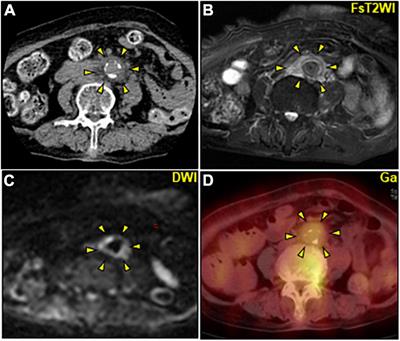 Decisive diagnostic clue for infectious abdominal aortic aneurysm caused by Arthrobacter russicus in a diabetic elderly woman with renal dysfunction: A case report and literature review